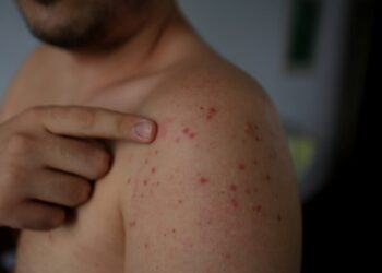 За перші три місяці 2025 року захворюваність на кір зросла в Україні удвадцятеро, дві дитини померли