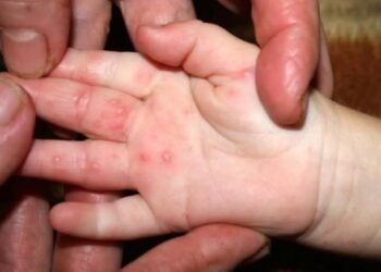 У Броварській громаді зафіксовано спалах захворювань, спричинених ECHO-вірусами